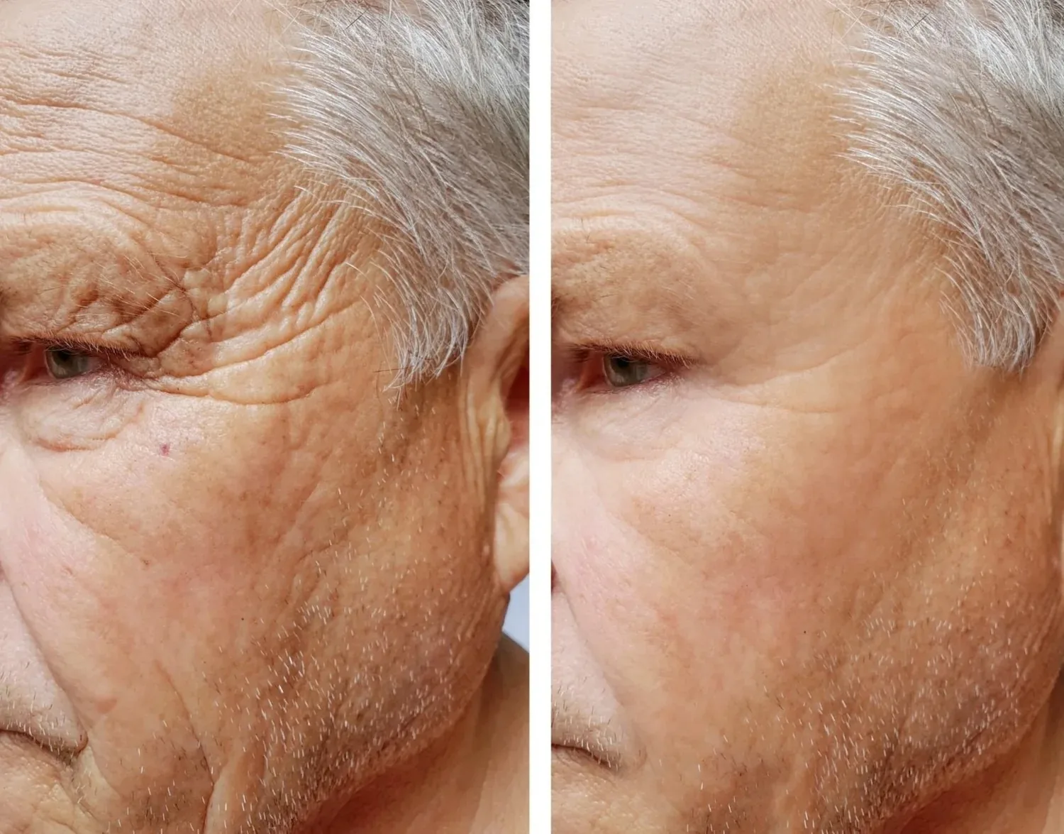 Before-and-after comparison of a person's facial wrinkles around the eye and cheek.