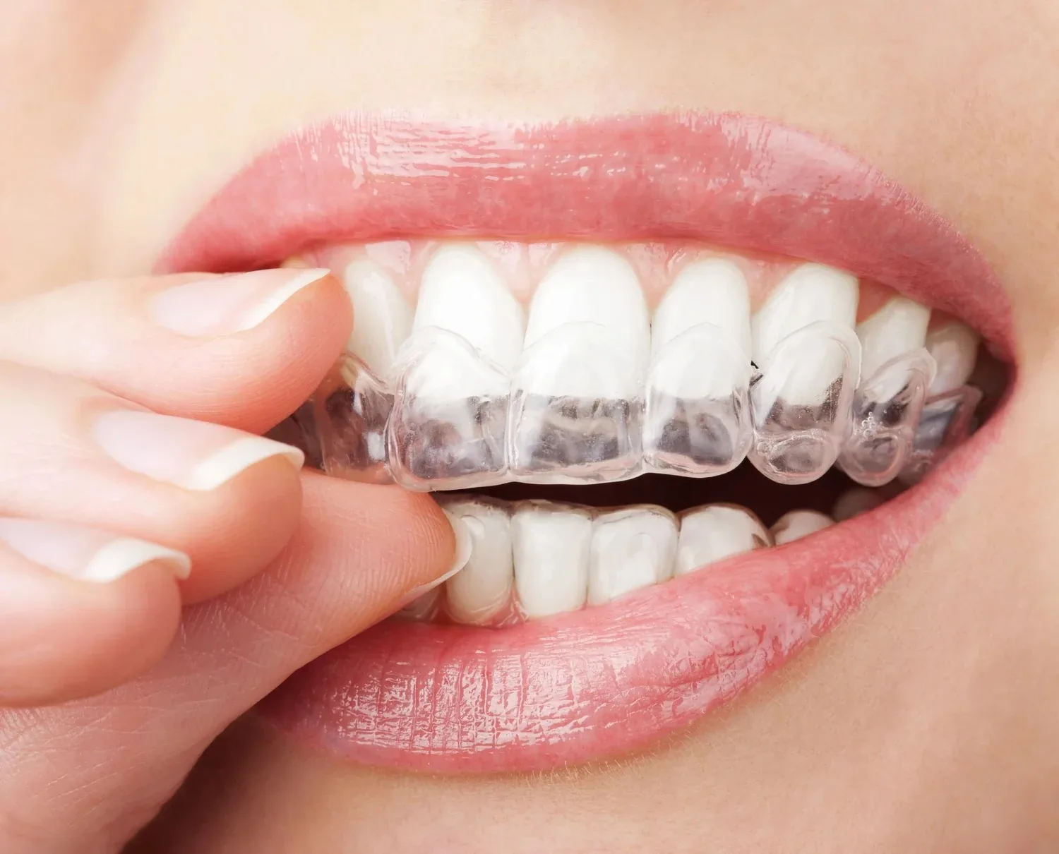 A person placing a clear plastic aligner onto their upper teeth.
